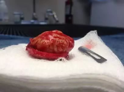 Baby-Maningioma