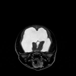 MRI diagnosis of hydrocephalus in dogs