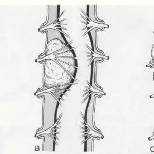 Myelographic-patterns - Lupa