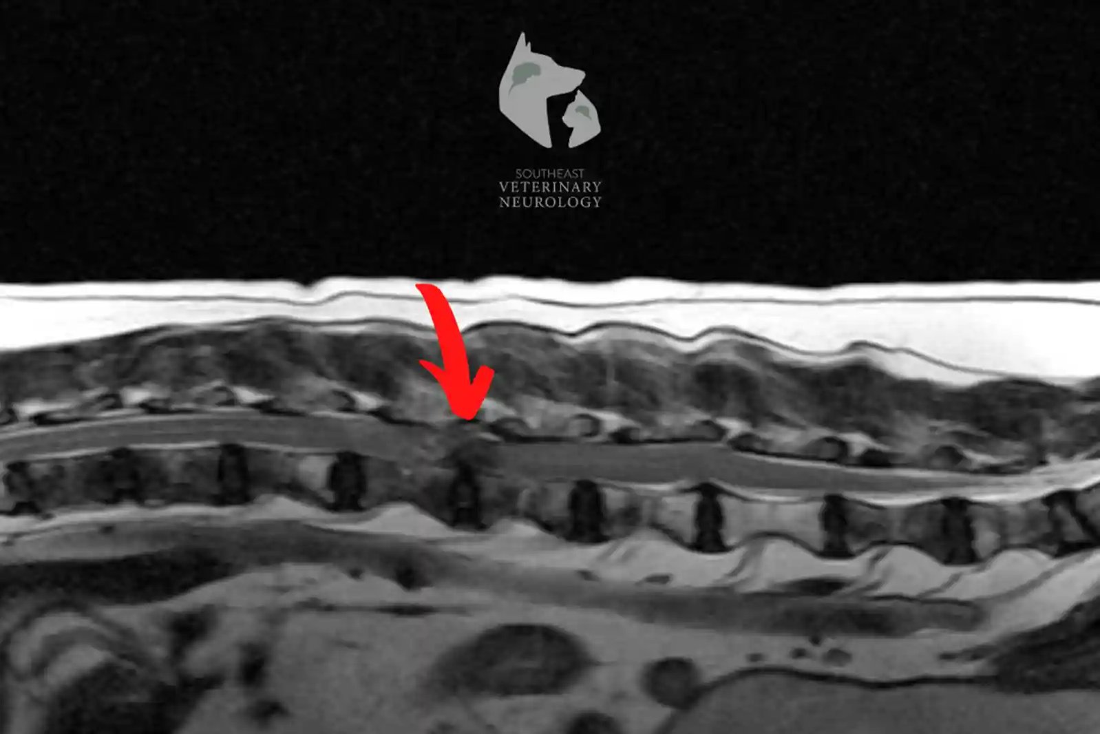MRI of spinal cord in dog with grade 5 ivdd at risk for myelomalacia